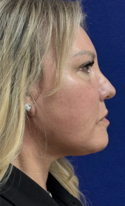 HourLift Before & After Patient #13012