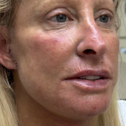HourLift Before & After Patient #13013