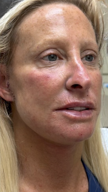 HourLift Before & After Patient #13013