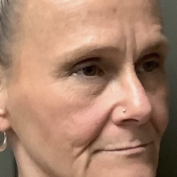 HourLift Before & After Patient #13015
