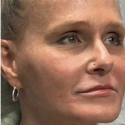 HourLift Before & After Patient #13015