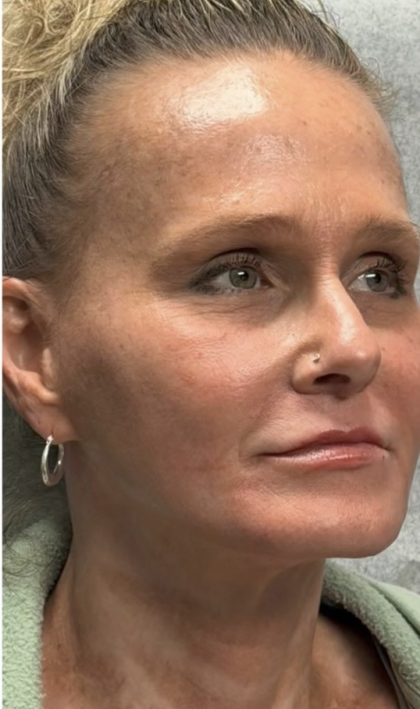 HourLift Before & After Patient #13015